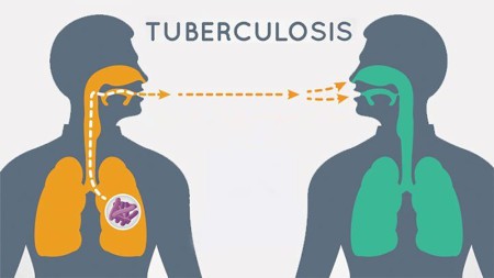 Tuberculosis Tb